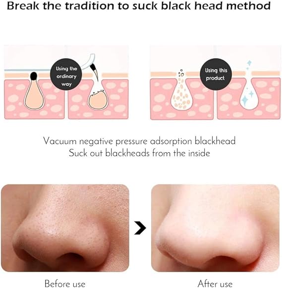 the ordinary blackheads before and after