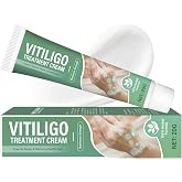 SERELVA Vitiligo Cream for Face and Body, Natural Herbal Cream for Spots | Soothing Skin Care to Even Skin Tone &amp; Restore Natural Looking Complexion, Gentle &amp; Fast Acting