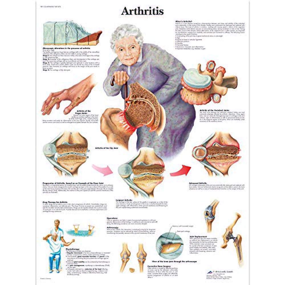 3B Scientific Human Anatomy - Arthritis Chart, Paper Version