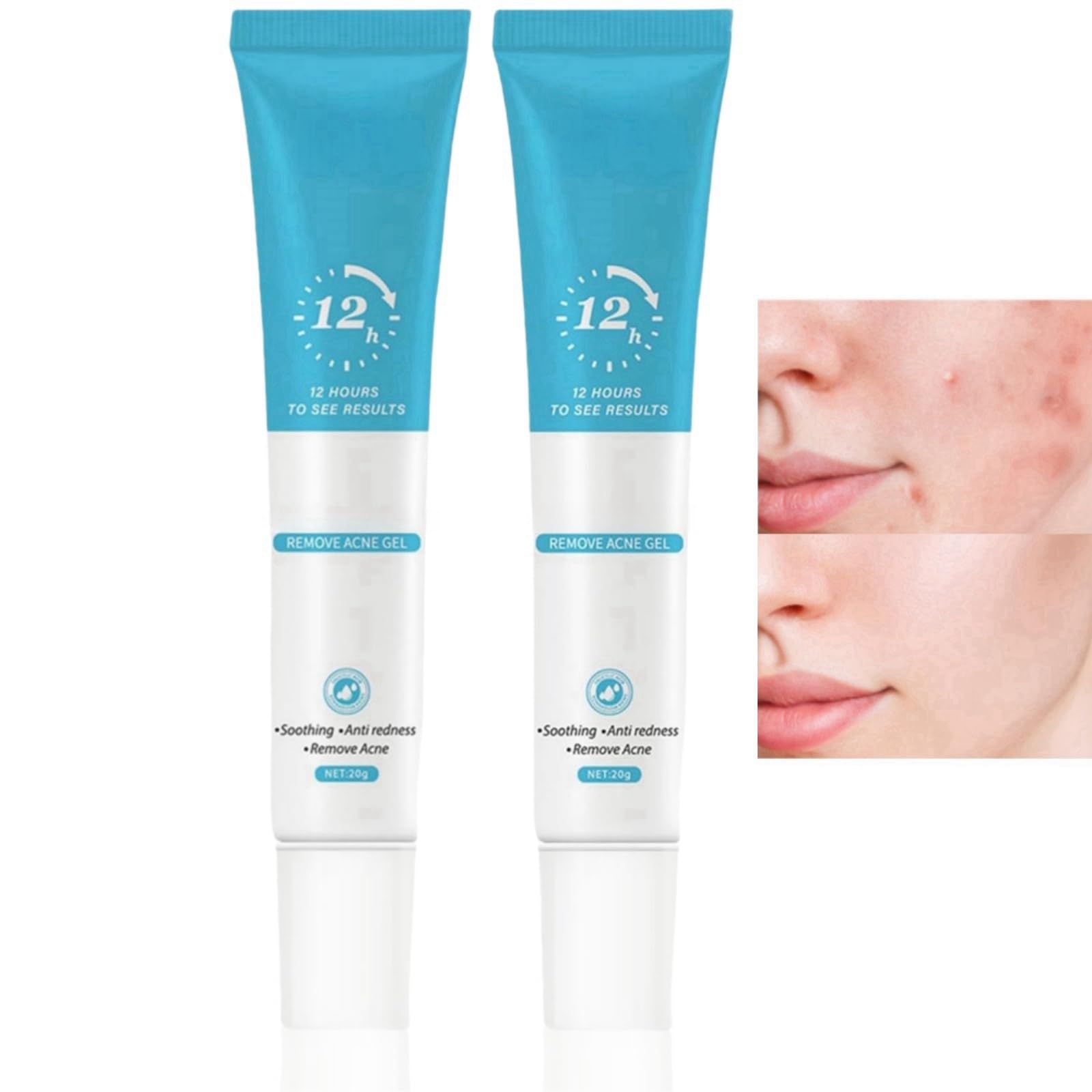2PCS Acne Spot Treatment Gel, Anti Acne Face Cream, Blackheads Treatment