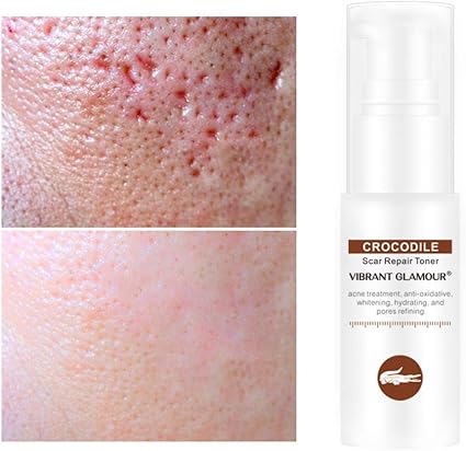 does toner help with acne scars