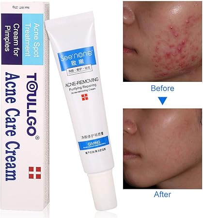 topical cream for acne scars