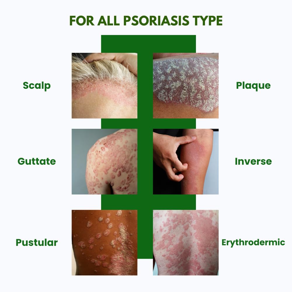 PSODEX Psoriasis Cream – 3.4fl oz Topical Psoriasis Treatment with Coal Tar, Salicylic Acid, Tea Tree Oil, Aloe Vera – All-Natural Ingredients – Soothing and Moisturizing Coal Tar Psoriasis Cream