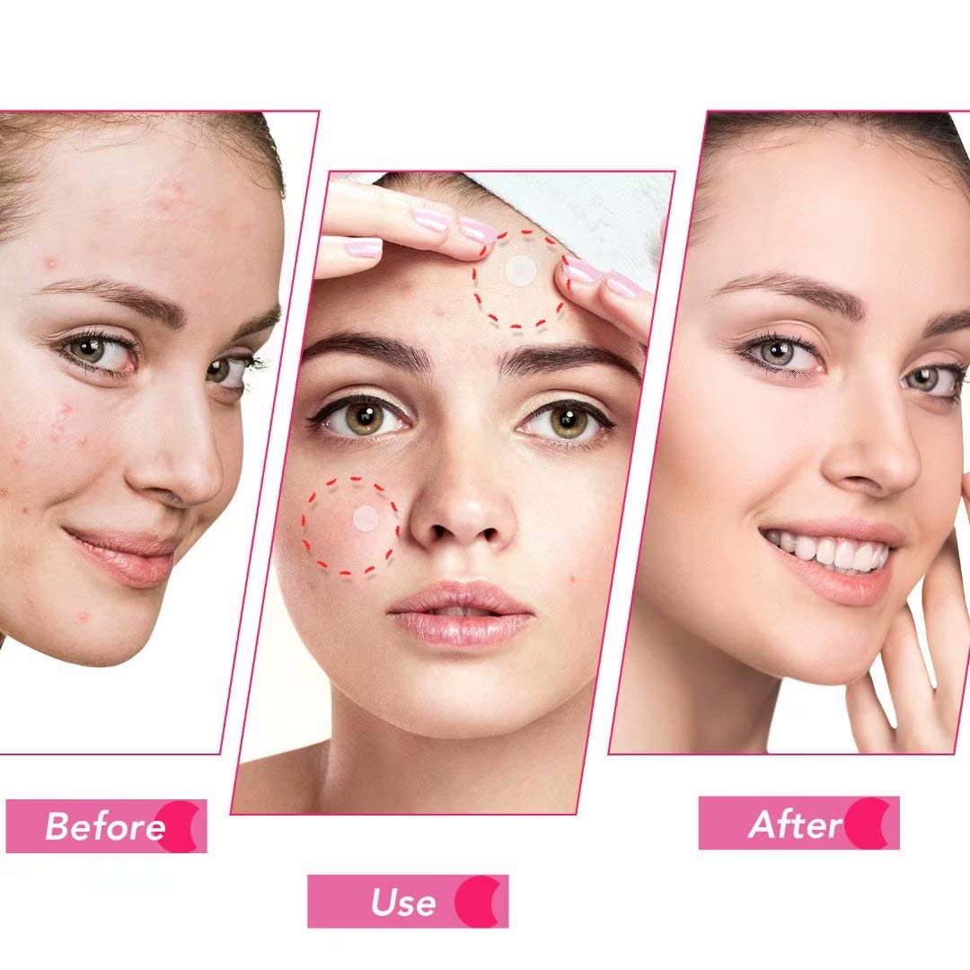 Acne Pimple Patch (120 Patches), Absorbing Hydrocolloid Spot Dots Treatment Master, Tea Tree Oil