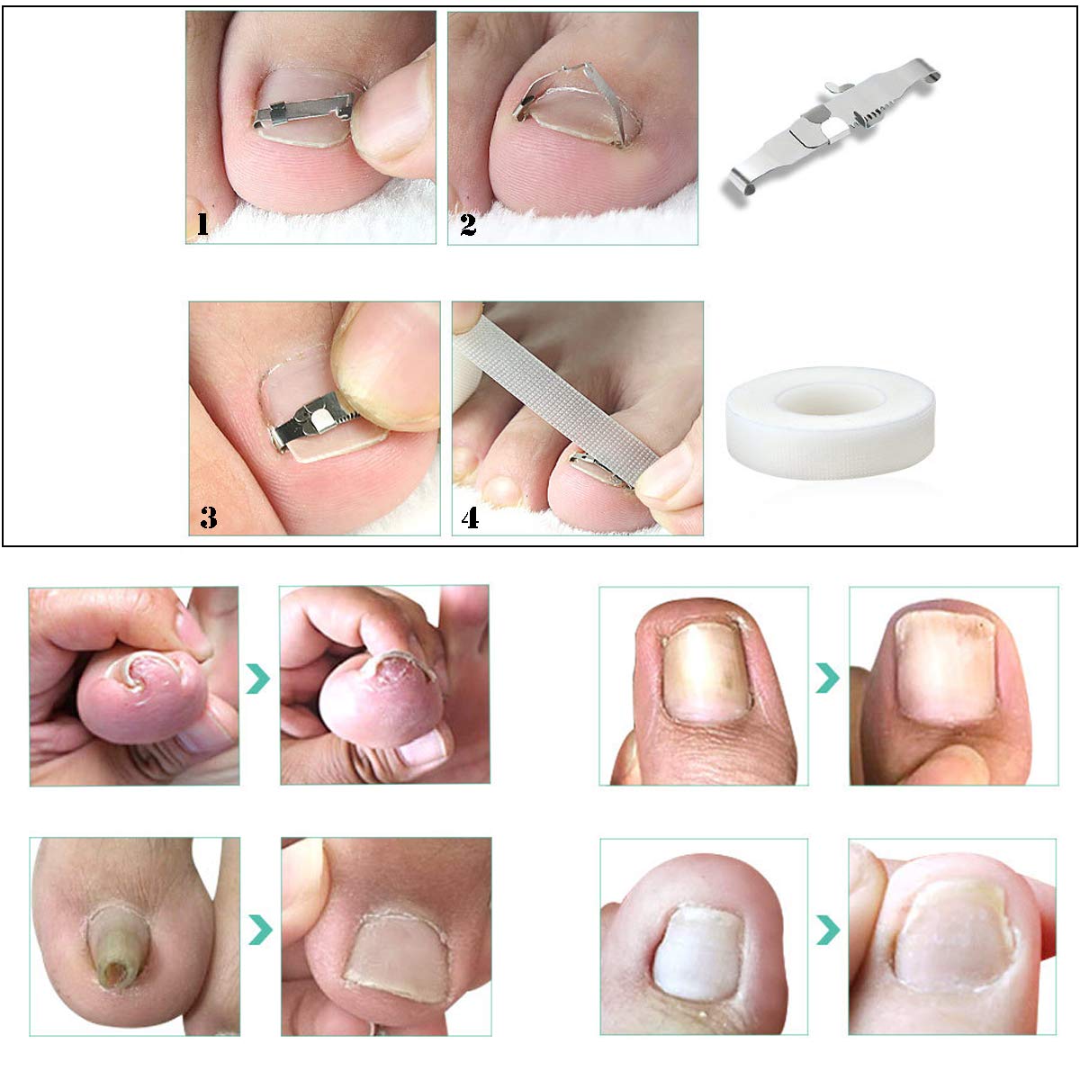 Ingrown Toenail Tools Kit, Include 2pcs Ingrown Toenail Correction Buckle and Toenail Lifter, 2 Sheets Ingrown Toenail Correction Patches for Ingrown Toe Nails Foot Care Tools: Beauty