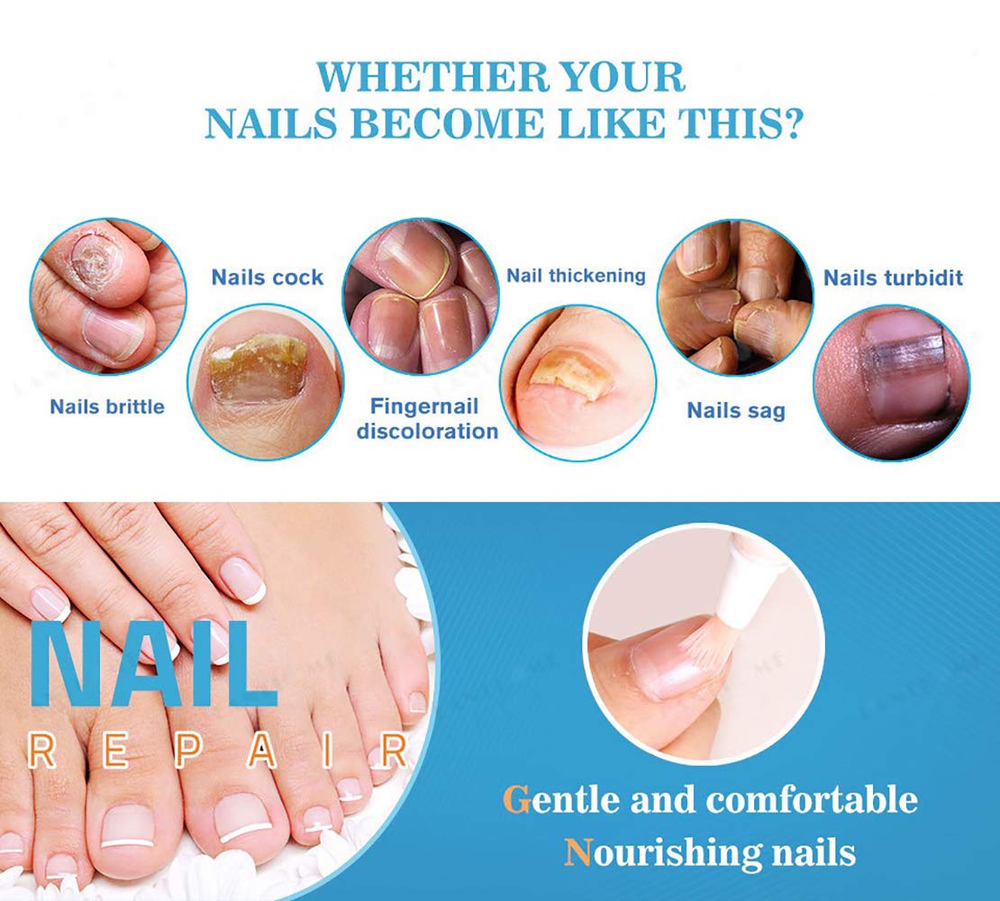 Eletist Nail Repair Pen Nail Fungus Treatment for Toenail Fungus Toenail and Nail Care Solution for Fixes and Restores Discolored and Damaged Nails : Beauty