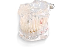 ESTINK Dental Tooth Model,Transparent Adult Pathologies Dental Study Teaching Teeth Model Dental Implant Disease Teaching Tools with Removable Tooth