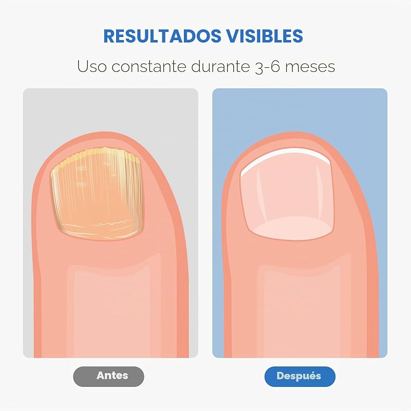 Dispositivo de Limpieza de Hongos en Uñas, Berrlly Dispositivo de Láser de Hongos Uñas 460nm Luz Azul Altamente Efectiva para Hongos en Las Uñas, Fácil de Usar en Casa, Personas Mayores(Negro) — foto 3 de 8