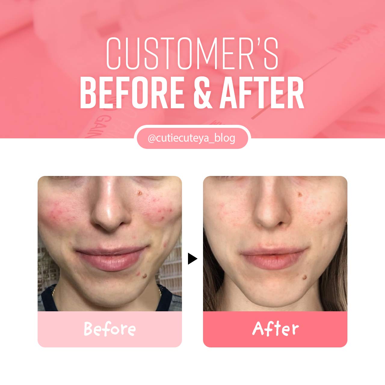 jumiso ac cure spot cream