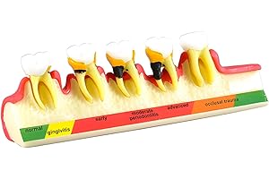 Resin Tooth Model, Demonstrating Periodontal Disease Stages, For Dental Patient Education, Gingivitis To Severe Periodontitis
