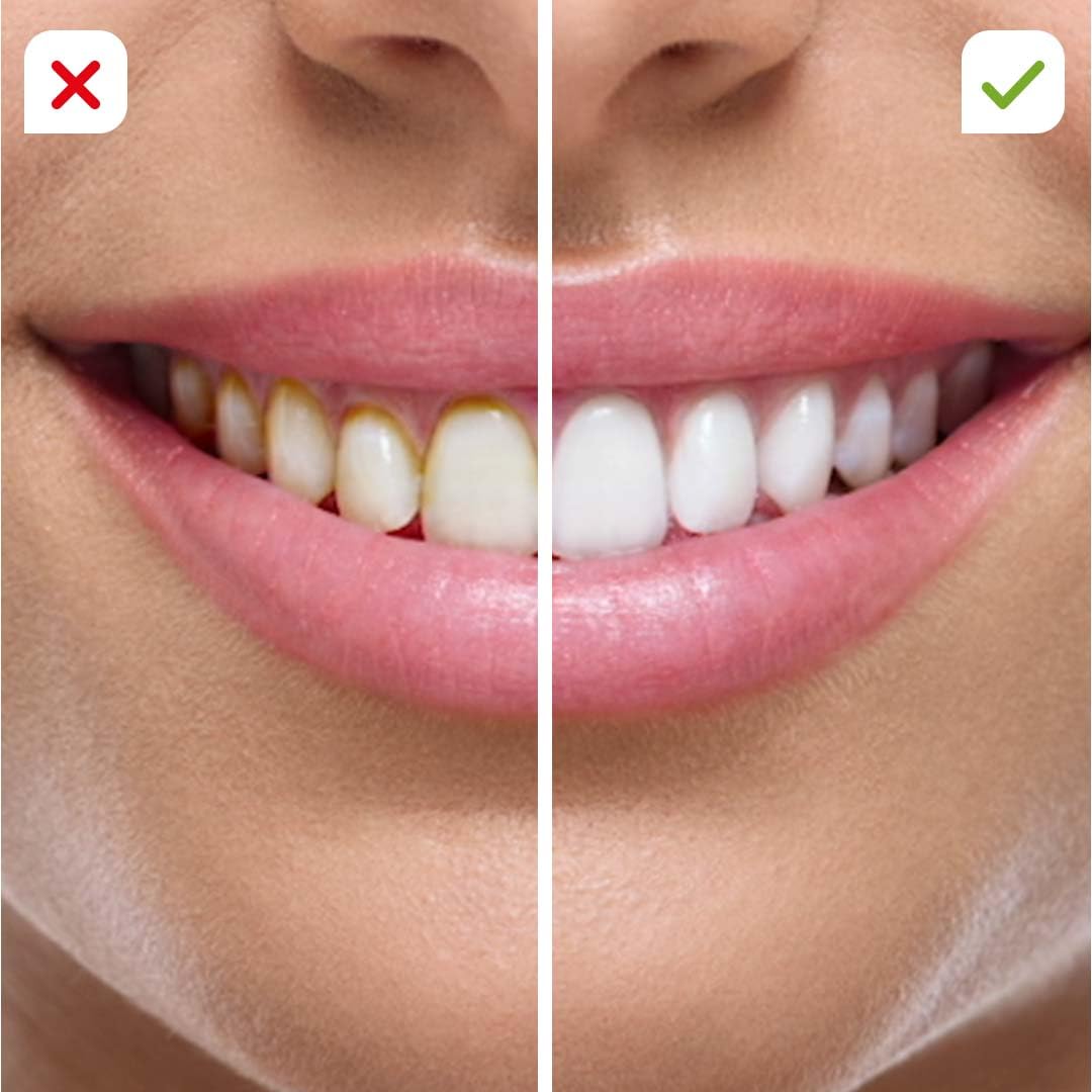 CorpCare Miracle Smile - Elektrische Munddusche - Zahnreinigung - Zahnhygiene - Kabellose Zahndusche - Mundhygiene 6