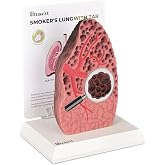 Ultrassist Smoking Lung Model with Tar Damage | Cross-sectional alveoli detail, durable easy-clean surface, for hospitals, schools, health education and exhibitions