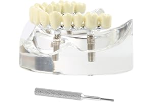 KOUYOT Dental Model Overdenture Transparent Dental Implants Model Upper Jaw with 4 Implants Detachable Denture Model Dental Teaching Model Suitable for Education and Study