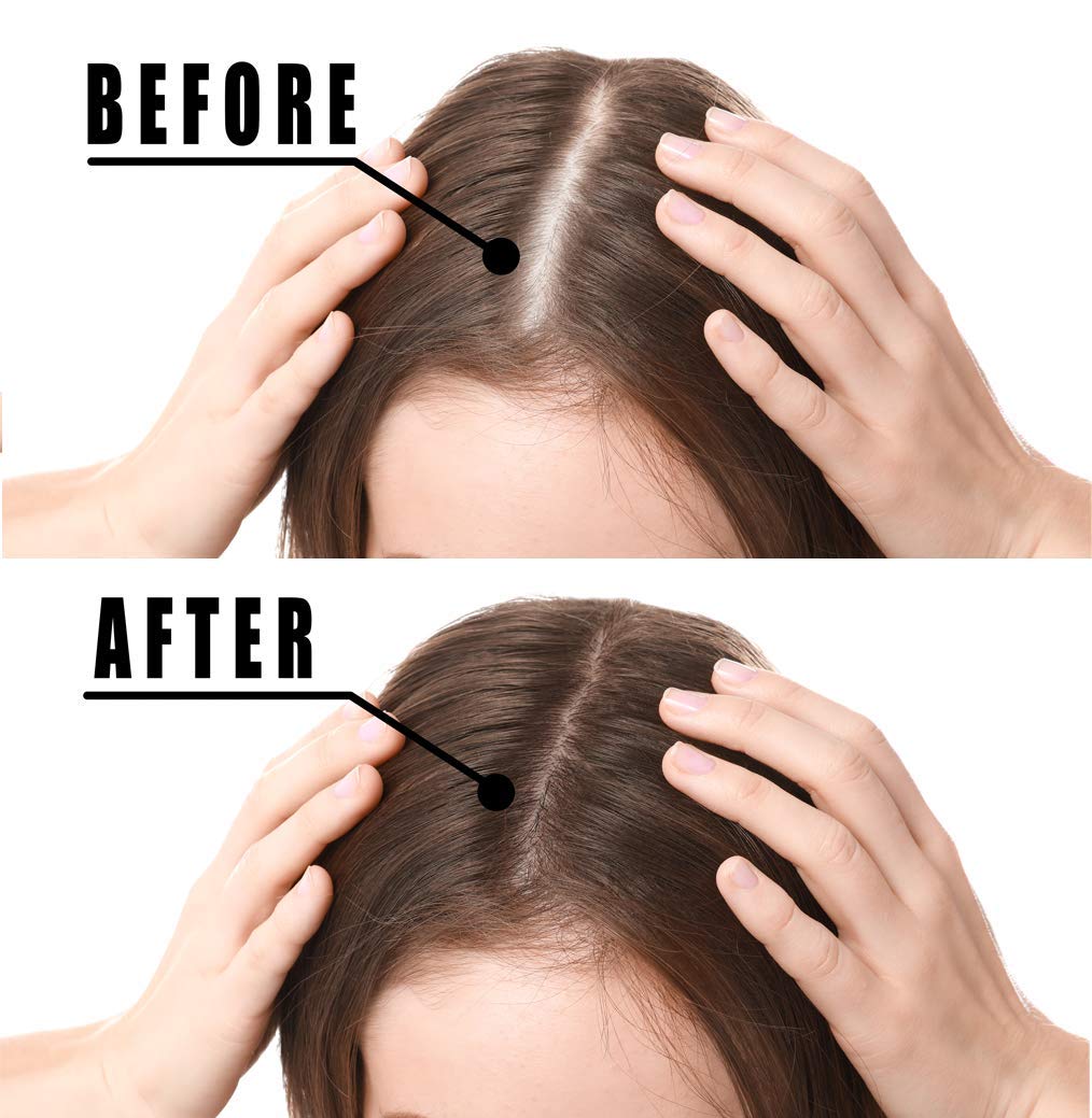 Hair Growth Serum, Votala Hair Growth Treatment, Hair Serum, Anti Hair Loss, Thinning, Balding, Repairs Hair Follicles, Promotes Thicker, Stronger Hair, And Promotes Hair Regrowth : Beauty