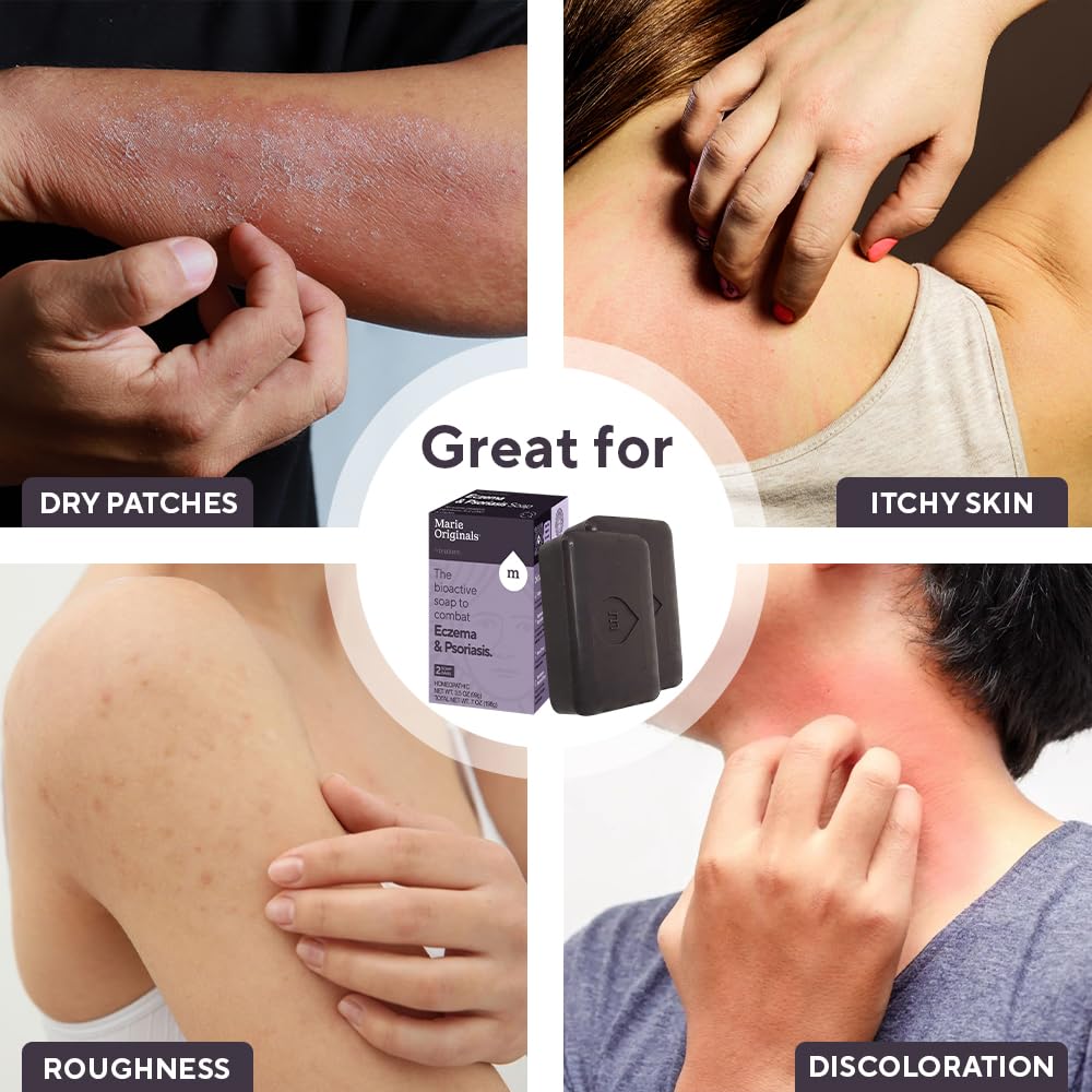 Marie Originals Eczema Face Soap Body Wash Bar – All Natural Psoriasis, Dermatitis Treatment for Dry Itchy Flaky Skin Relief – Gentle Detoxifying, Healing, Anti-Itch, Cleansing Skincare (Pack of 2)