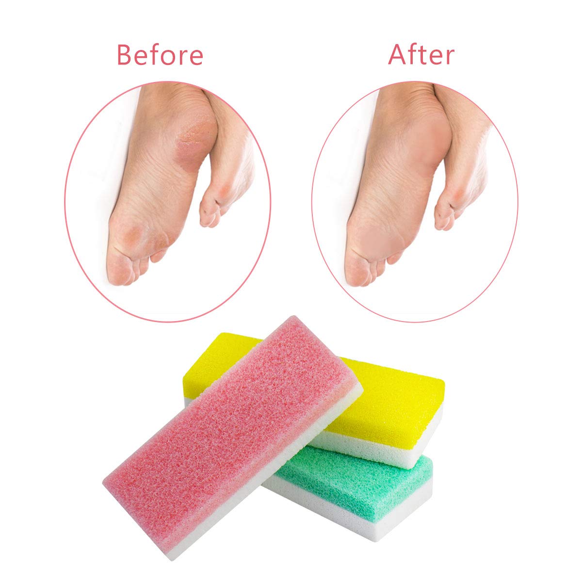 Foot Pumice Stone for Feet, 2 in 1 Double Sided Hard Skin Callus Remover Scrubber Pedicure Exfoliator Tool for Dead Skin Pack of 6: Beauty