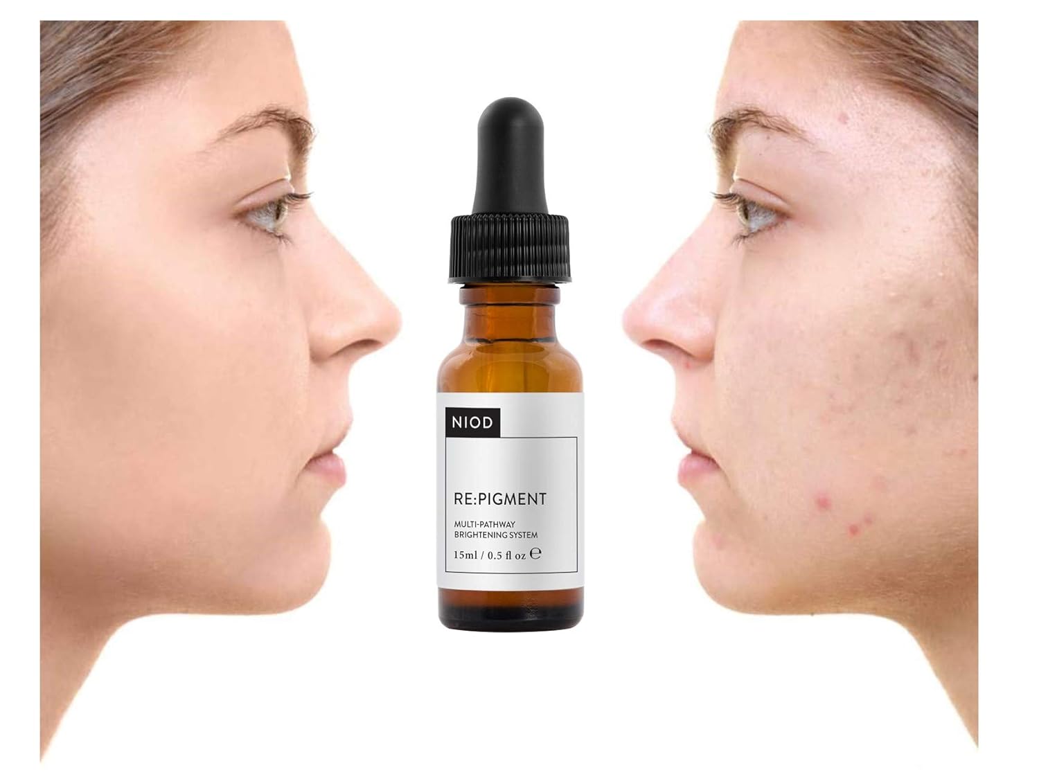 niod azelaic acid