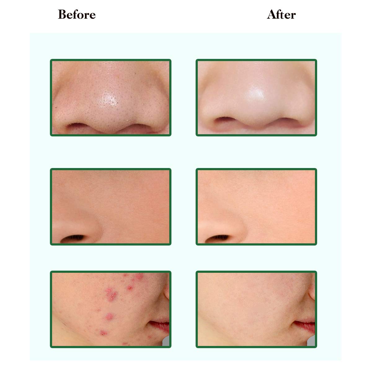 Pure Natural Dead Sea Mud Mask for Face and Body,Purifying Face Mask for Acne, Blackheads. Facial Pore Minimizer, Reducer & Pores Cleanser Treatment