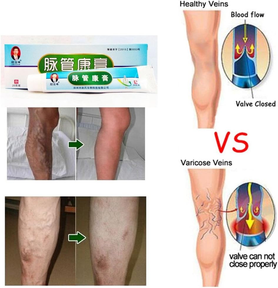 Varicose Vein Enlargement Ointment Cream,Allouli Lumps Old Bad Leg Vasculitis Cream Chinese Medicine,Rotten Blood Health Care(20g) (A)