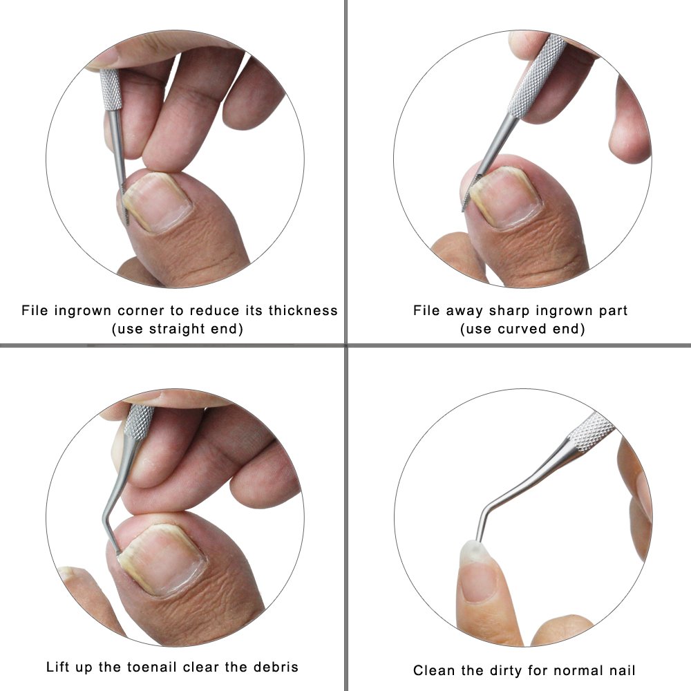ZIZZON Ingrown Toenail File and Lifter Double Sided Professional Grade: Beauty