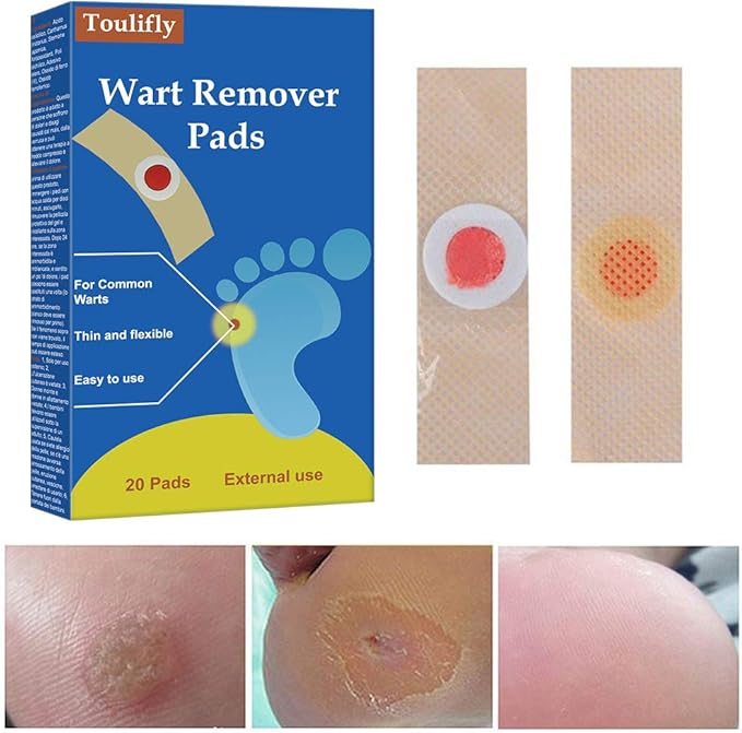 Wart Remover, Wart Removal Treatment, Corn Remover, Foot Corn Remover