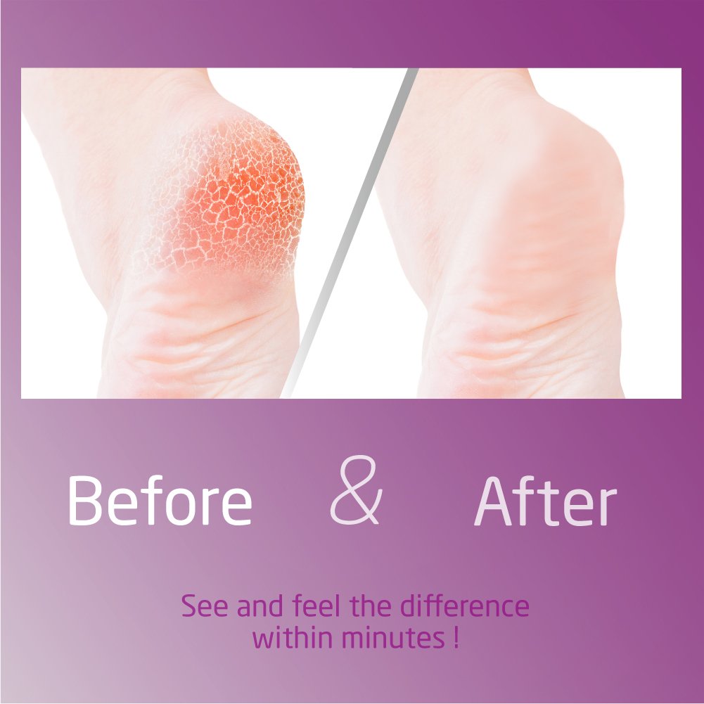 AVANTEK Elektrische Hornhautentferner zur Fußpflege, 100% Wasserfest, Pediküre Werkzeug inkl. 2 Schleifrollen