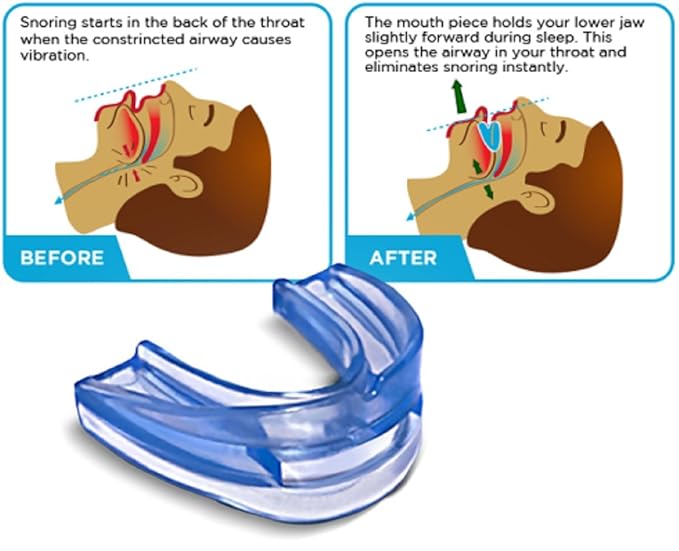CIO - Dispositivo antirronquidos para adultos (apneas del sueño): Amazon.es: Hogar