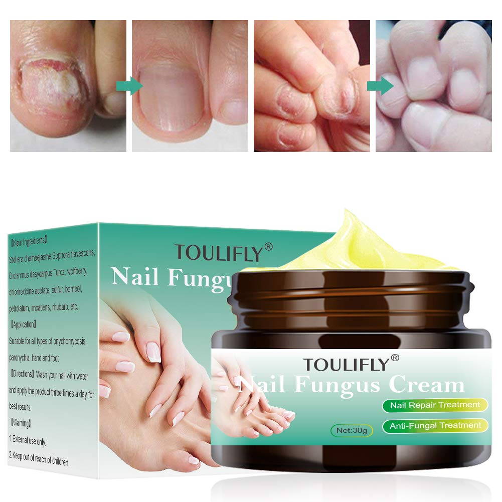 Nail Fungus Cream,Toenail Fungus Treatment,Nail Fungus Remover,Toenail