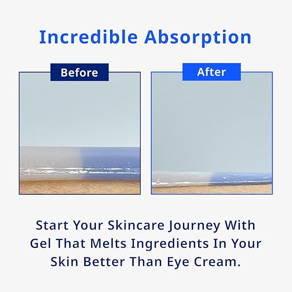 MISOLI MOIST MOMENT UNDER EYE PATCHES | HYDRATING EYE TREATMENT GEL MASKS WITH HYALURONIC ACID & SQUALANE | UNDER EYE MASKS FOR DARK CIRCLES AND PUFFINESS, UNDER EYE BAGS, WRINKLE CARE, MEN AND WOMEN