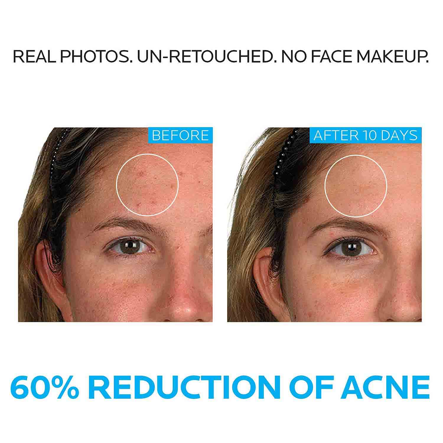 La Roche-Posay Effaclar Dermatological 3 Step Acne Treatment System, Salicylic Acid Acne Cleanser, Pore Refining Toner, and Benzoyl Peroxide Spot Treatment for Sensitive Skin