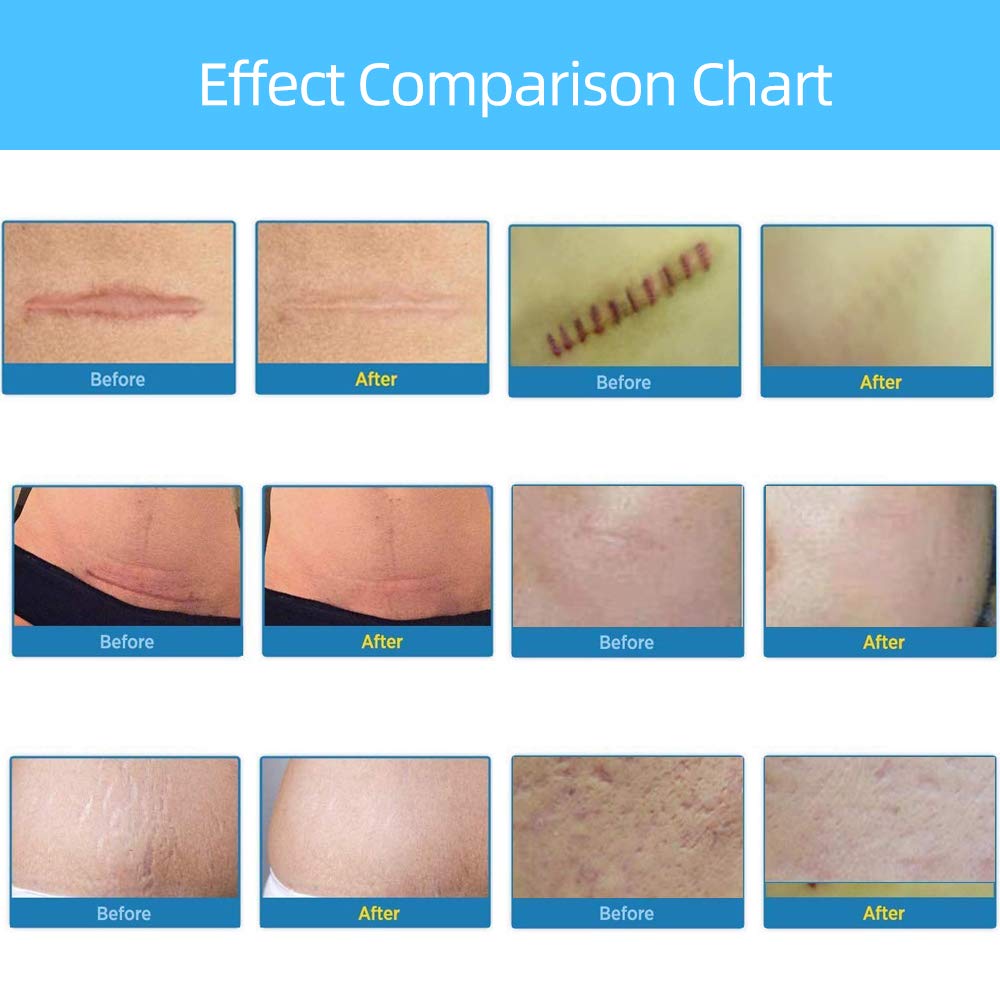 Professional Soft Silicone Scar Sheets, Prevents & Treats All Scars, Soften and Flattens Scars Resulting from C-section, Surgery, Injury, Burns, Acne, 5.9"×1.38", 5 Sheets(5 Months Supply)… : Beauty