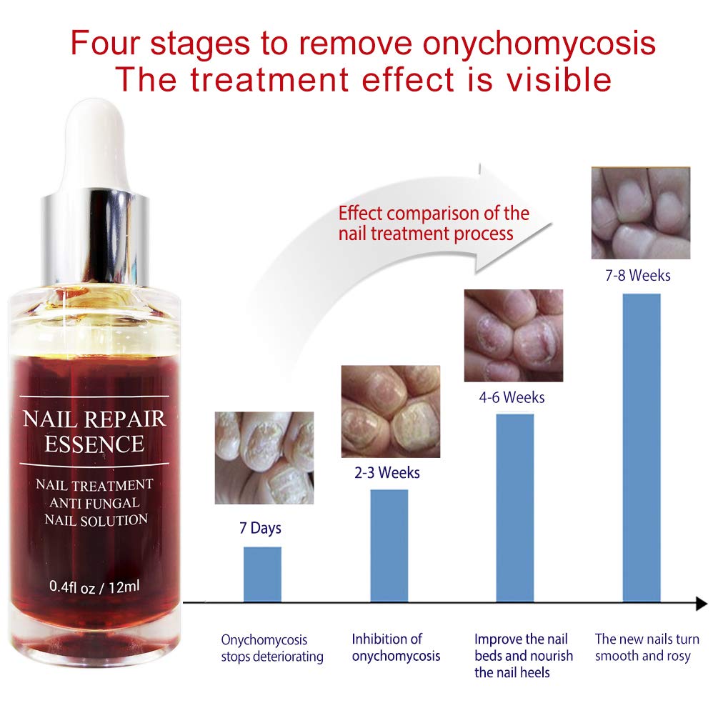 Fanmin Toenail and Nail Repair Essence, Remove Paronychia Onychomycosis Toe, Toenail and Nail Care Solution, Toenail and Nail Renewal, Fixes and Restores Discolored and Damaged Nails : Beauty