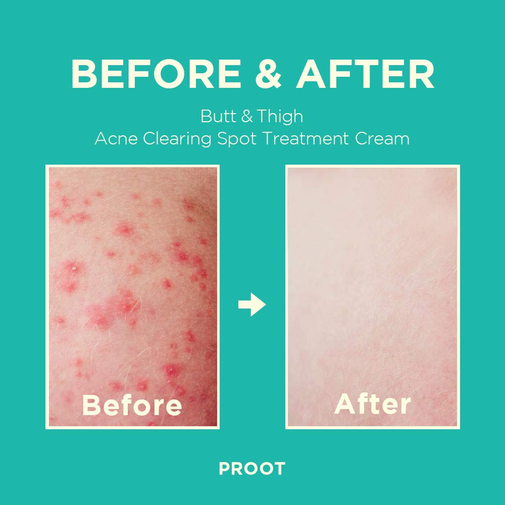 bum spot cream