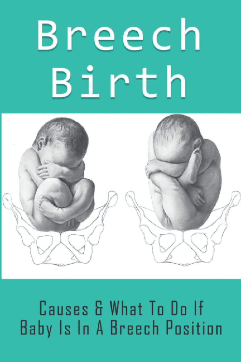 Mua Breech Birth: Causes & What To Do If Baby Is In A Breech Position ...