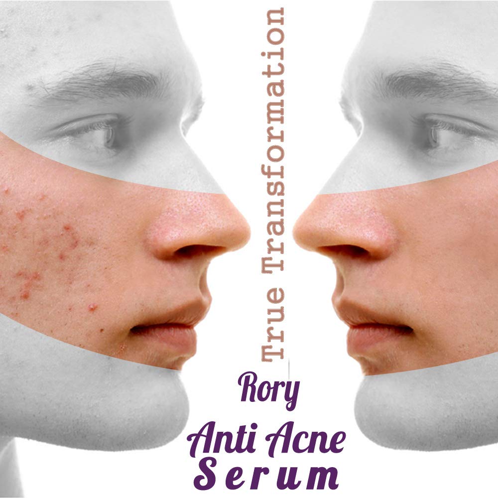 rory anti acne serum