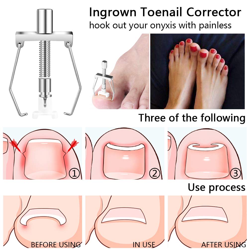ViYoung Ingrown Toenail Lifter Ingrown Toenail Tool, Ingrown Toenail Lifter，Toe Nail Correction Tool Pedicure Tool for Paronychia Treatment: Beauty