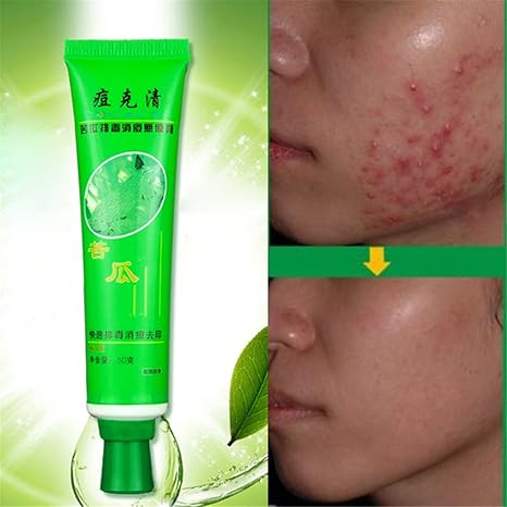 effective acne treatment