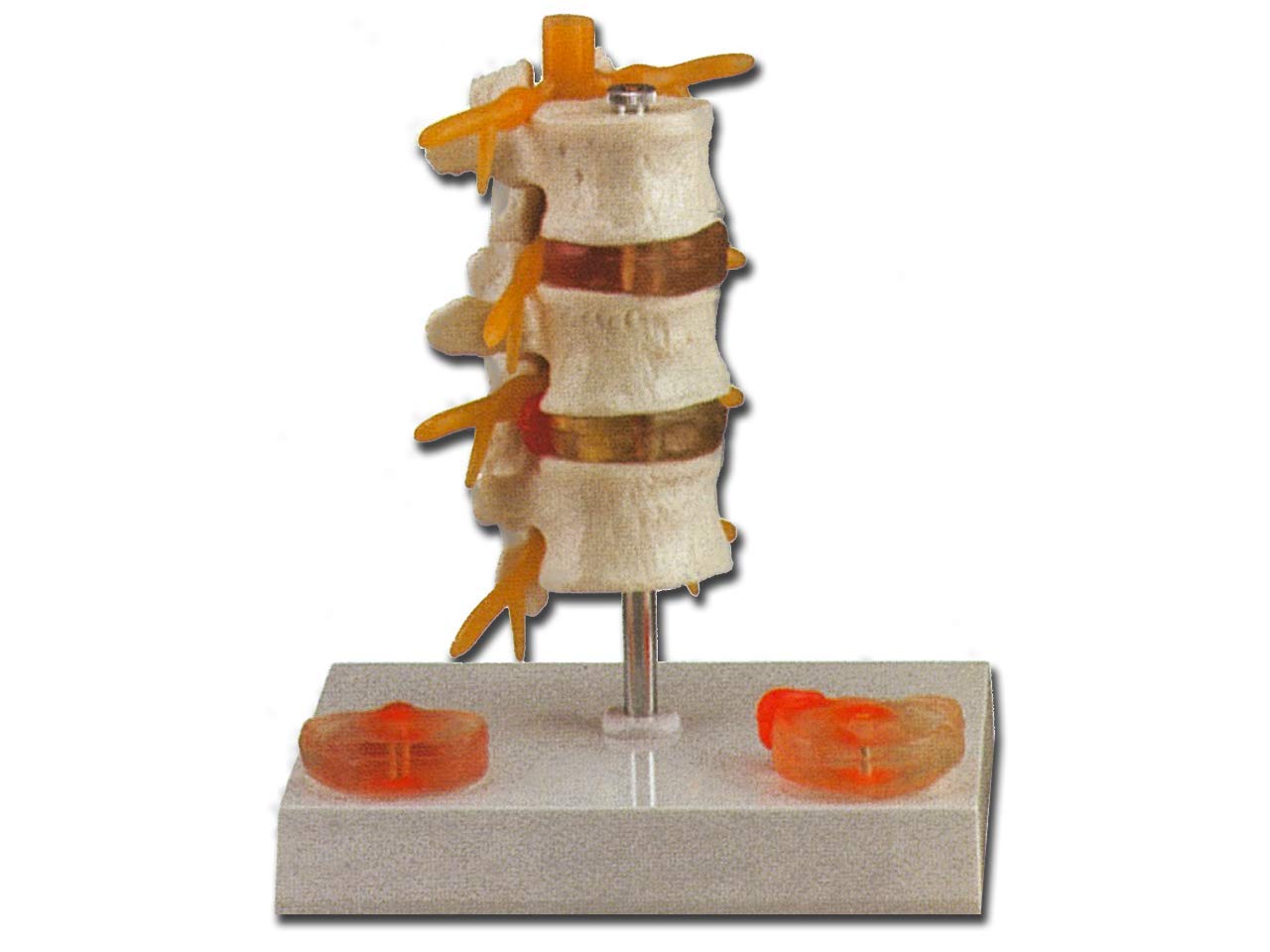 Gima - Anatomical Model of 3 Vertebrae with Hernia and Prolapsed Disc, Highly Detailed, Magnification 1X