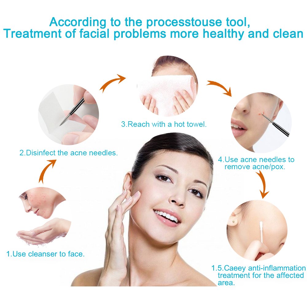 Blackhead Remover Tool,Sedremm 5 in 1 Acne Pimple Extractor Stainless Steel Tweezer Kit with Mirror and 10 PCS Alcohol Cotton Pads Treatment for Zit Comedone Whiteheads Blemish Removal