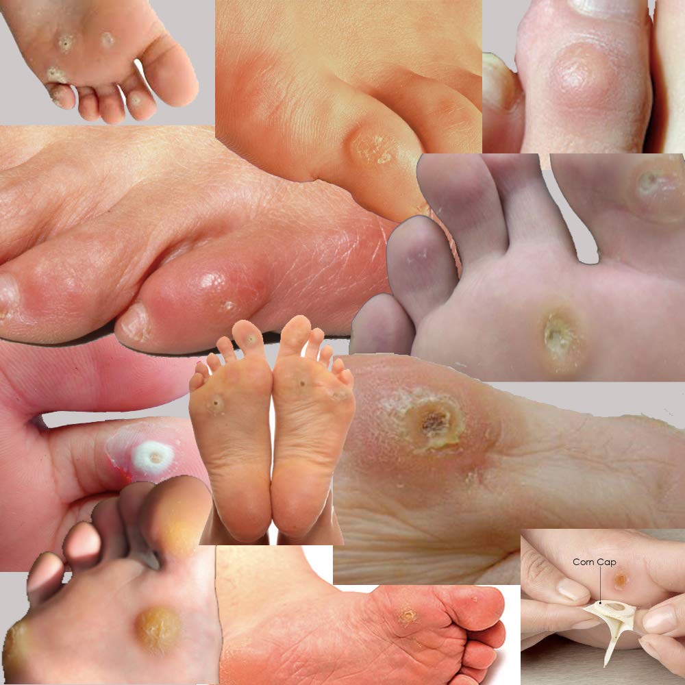 Corn remover for feet-salicylic acid pads to cushion your foot with powerful medicine for the professional treatment of tough to remove corns, warts and calluses on toes and feet. : Beauty