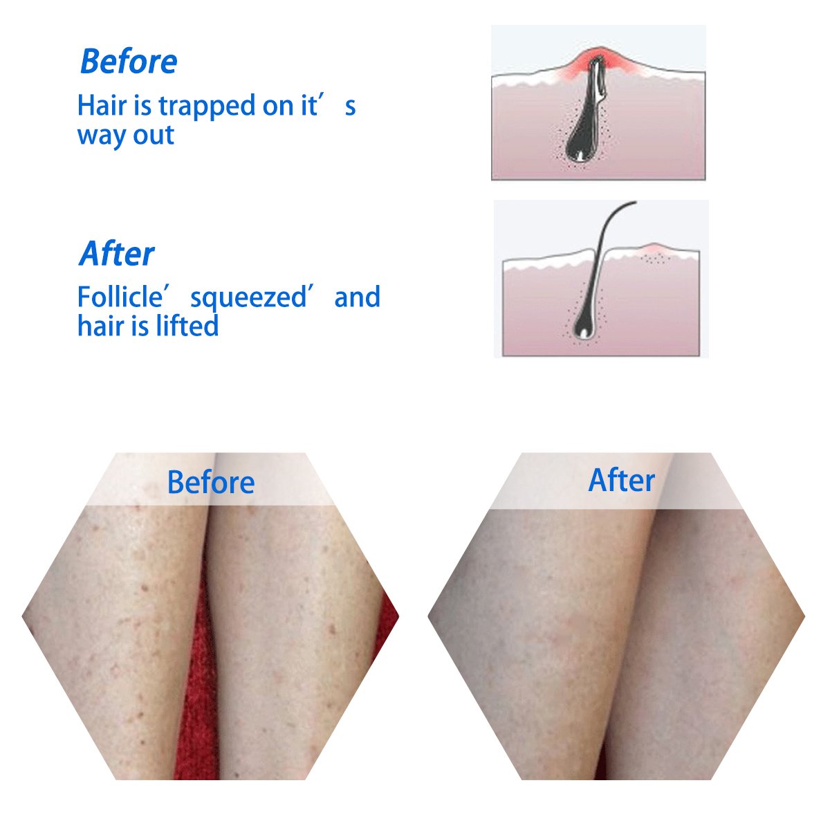 Codream Bristle Massage Brush For Eliminating Razor Bumps And