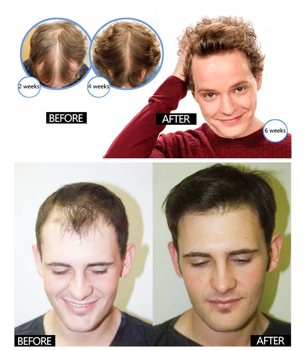 Hair Growth Serum, 2021 Hair Growth Treatment, Hair Serum, Anti Hair Loss, Thinning, Balding, Repairs Hair Follicles, Promotes Thicker, Stronger Hair, And Promotes Hair Regrowth : Beauty