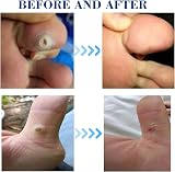 MQ Corn Remover Pads 24 Pcs Corn Plasters with Hole Foot Care Patch view 4