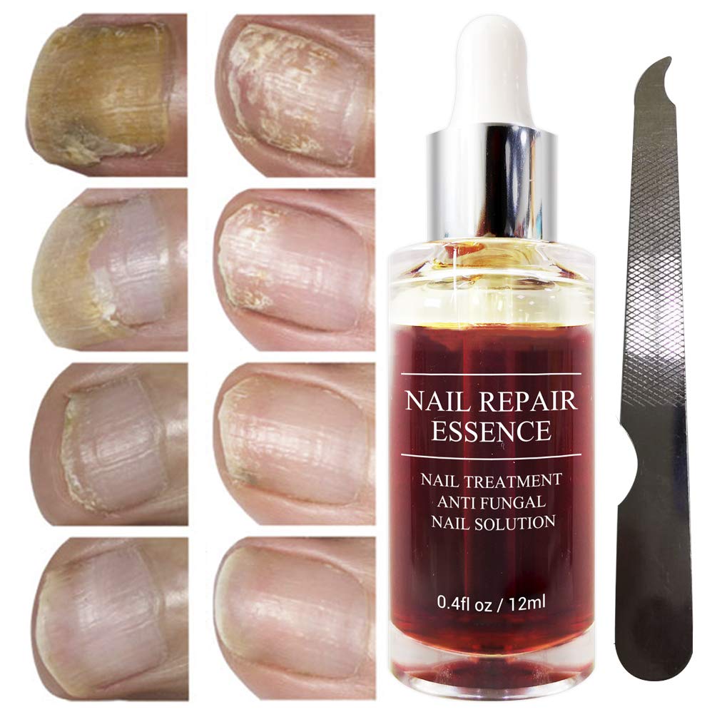 Fanmin Toenail and Nail Repair Essence, Remove Paronychia Onychomycosis Toe, Toenail and Nail Care Solution, Toenail and Nail Renewal, Fixes and Restores Discolored and Damaged Nails : Beauty