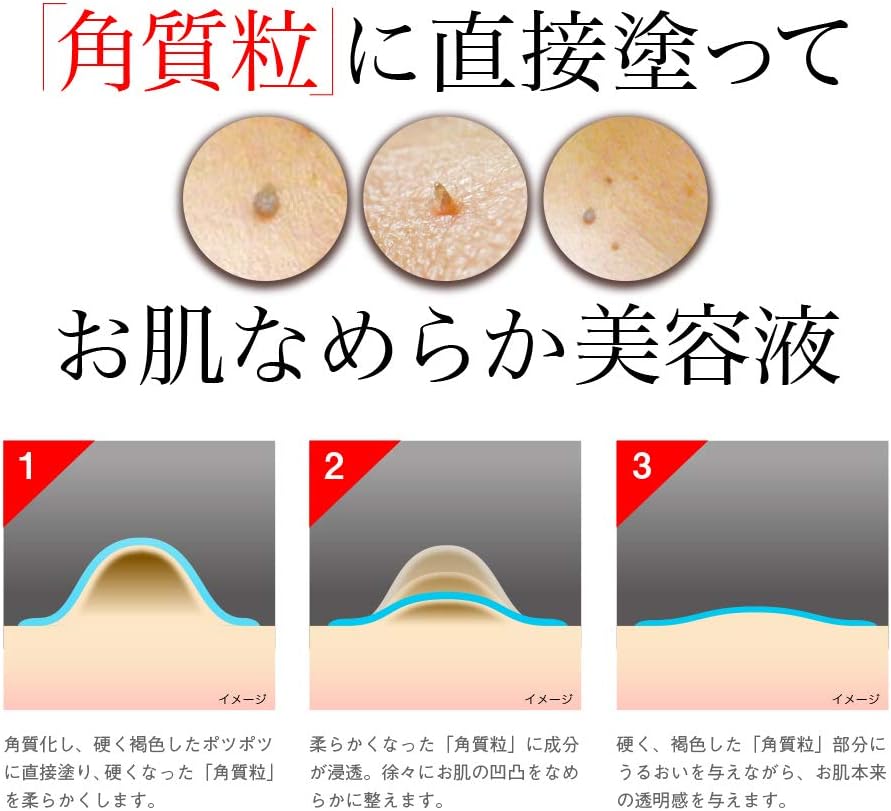 Amazon 角質粒 気になるポツポツ角質粒をケア イポケアex イポケアex サプリメント ビタミン Amazon 角質粒 気になるポツポツ角質粒をケア イポケアex イポケアex サプリメント ビタミン