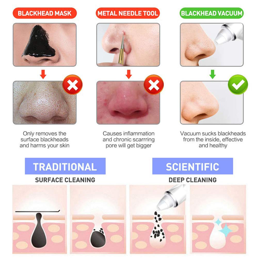 Blackhead Vacuum - Pore Vcauum Blackhead Remover Comedone Extractor Tool and Facial Skin Cleaner Suction Microdermabrasion Machine