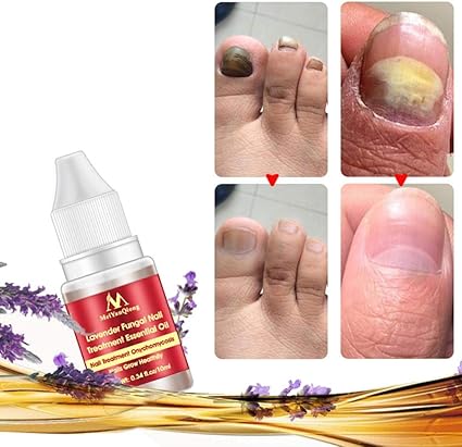 Onychomycose Ongles Des Onychomycoses De Traitement De L