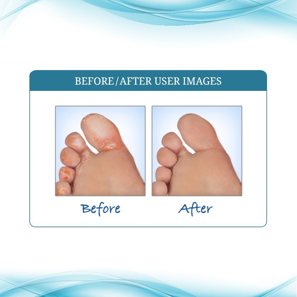 Funginix Nail Fungus Treatment and Funginix AF Athlete's Foot Treatment