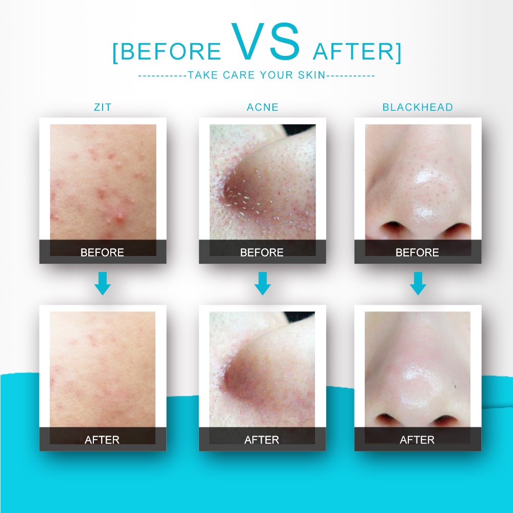 Blackhead Remover Tool,Sedremm 5 in 1 Acne Pimple Extractor Stainless Steel Tweezer Kit with Mirror and 10 PCS Alcohol Cotton Pads Treatment for Zit Comedone Whiteheads Blemish Removal