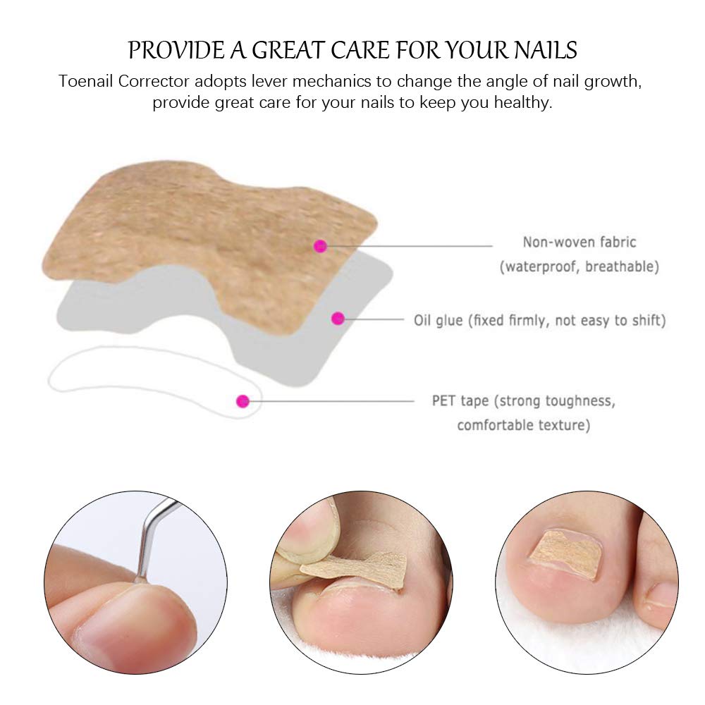 DKAF 5 Sheets Glue Free Toenail Patch with 1 Pcs Nail Hook, Ingrown Toenail Removal Correction Patch Foot Nail Treatment Tool, Toenail Correction Sticker: Beauty